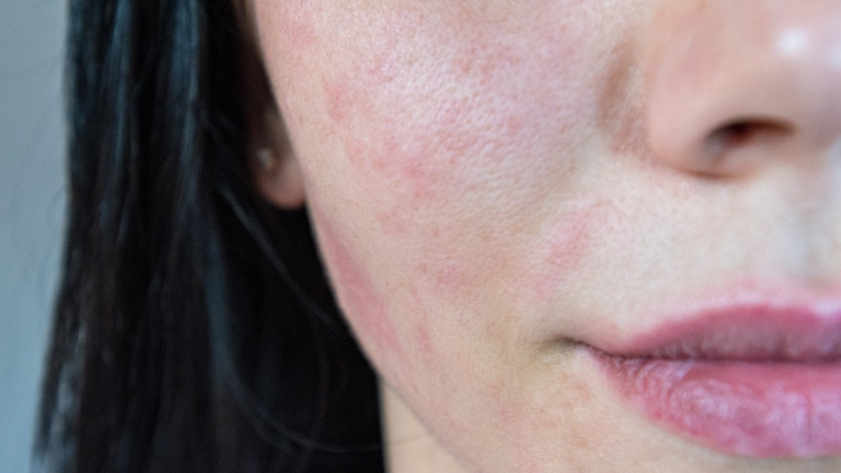 Rozācija un sejas apsārtums – dermatoloģija myEmerg lietotnē