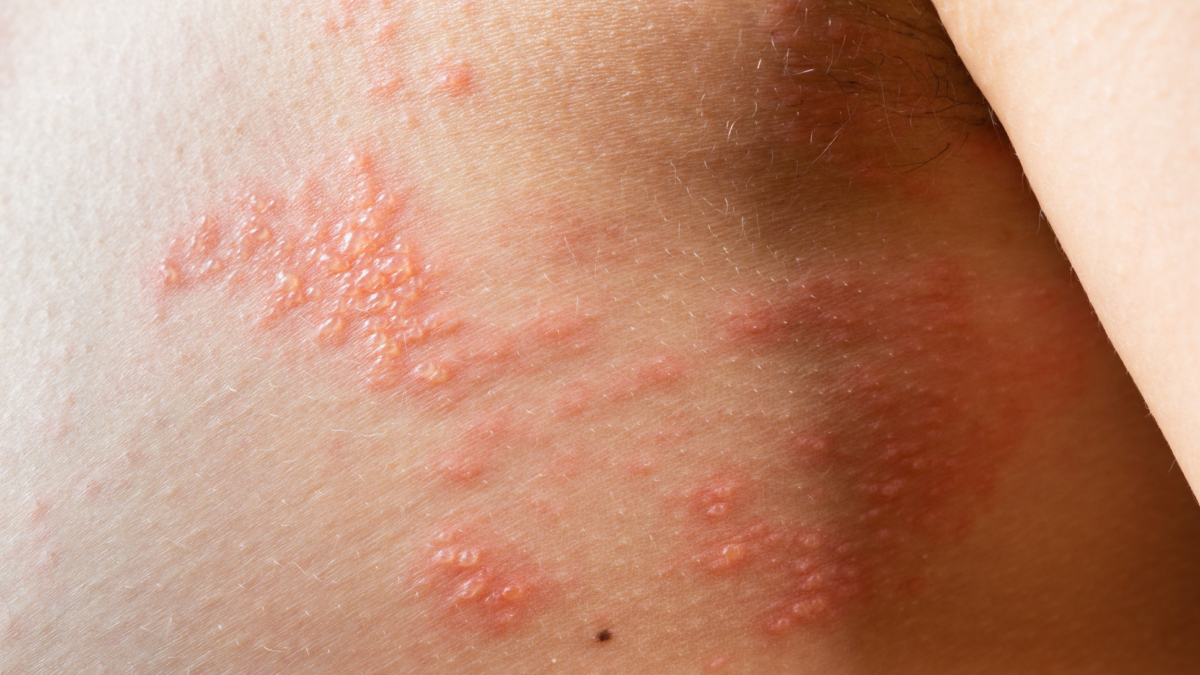 Fitofotodermatīts un ādas apdegumi no augiem – ārsta konsultācija tiešsaitē