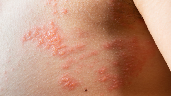 Fitofotodermatīts un ādas apdegumi no augiem – ārsta konsultācija tiešsaitē