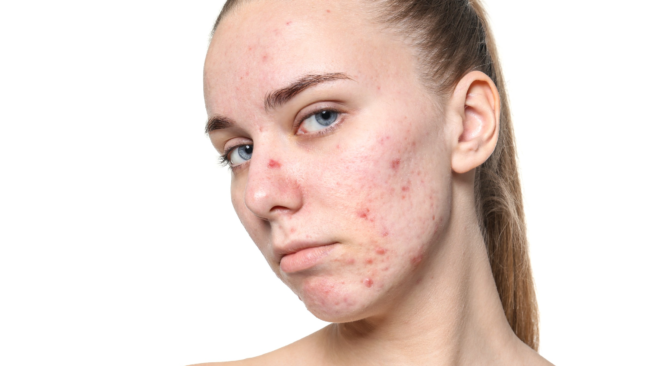 Sejas ādas akne un pūtītes – dermatologa konsultācija MyEmerg lietotnē