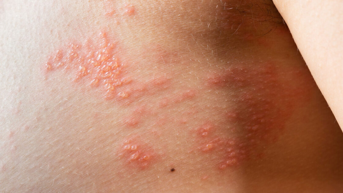 Fitofotodermatīts un ādas apdegumi no augiem – ārsta konsultācija tiešsaitē