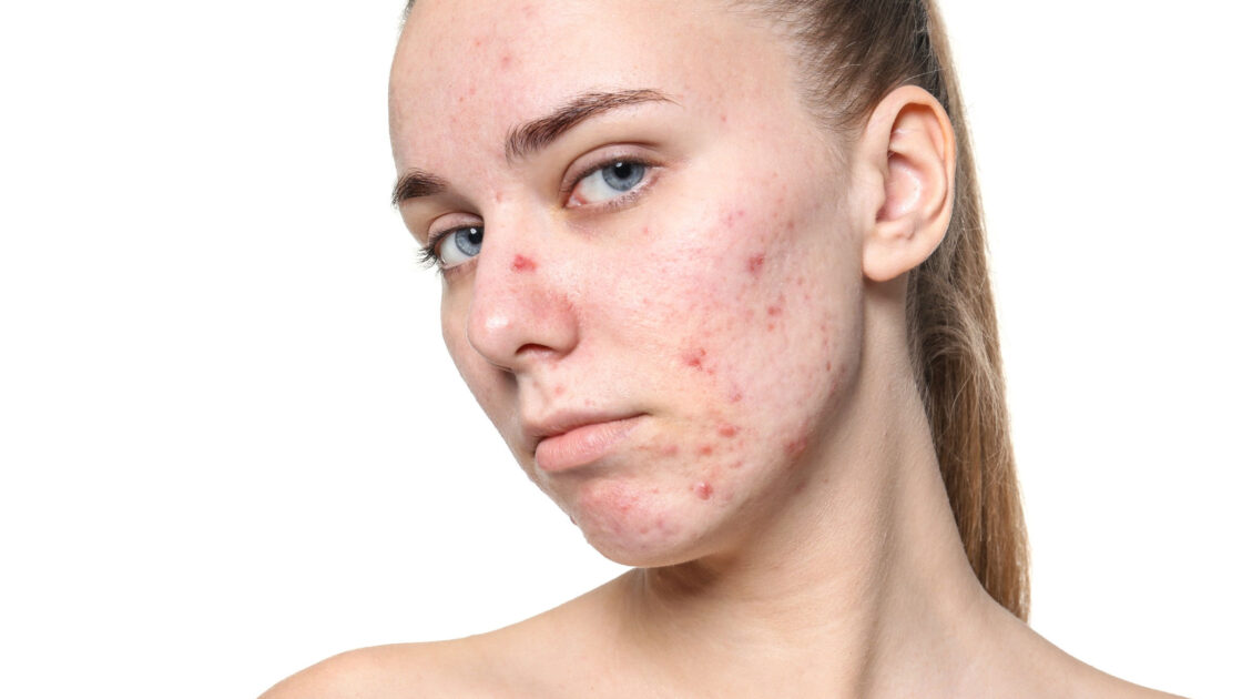 Sejas ādas akne un pūtītes – dermatologa konsultācija MyEmerg lietotnē